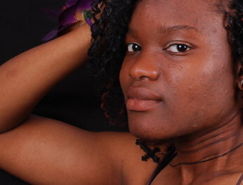 Natural Ingredients to Combat Acne